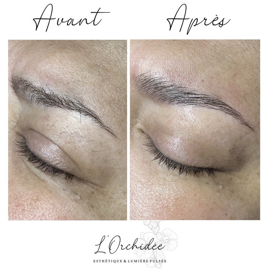 Browlamination