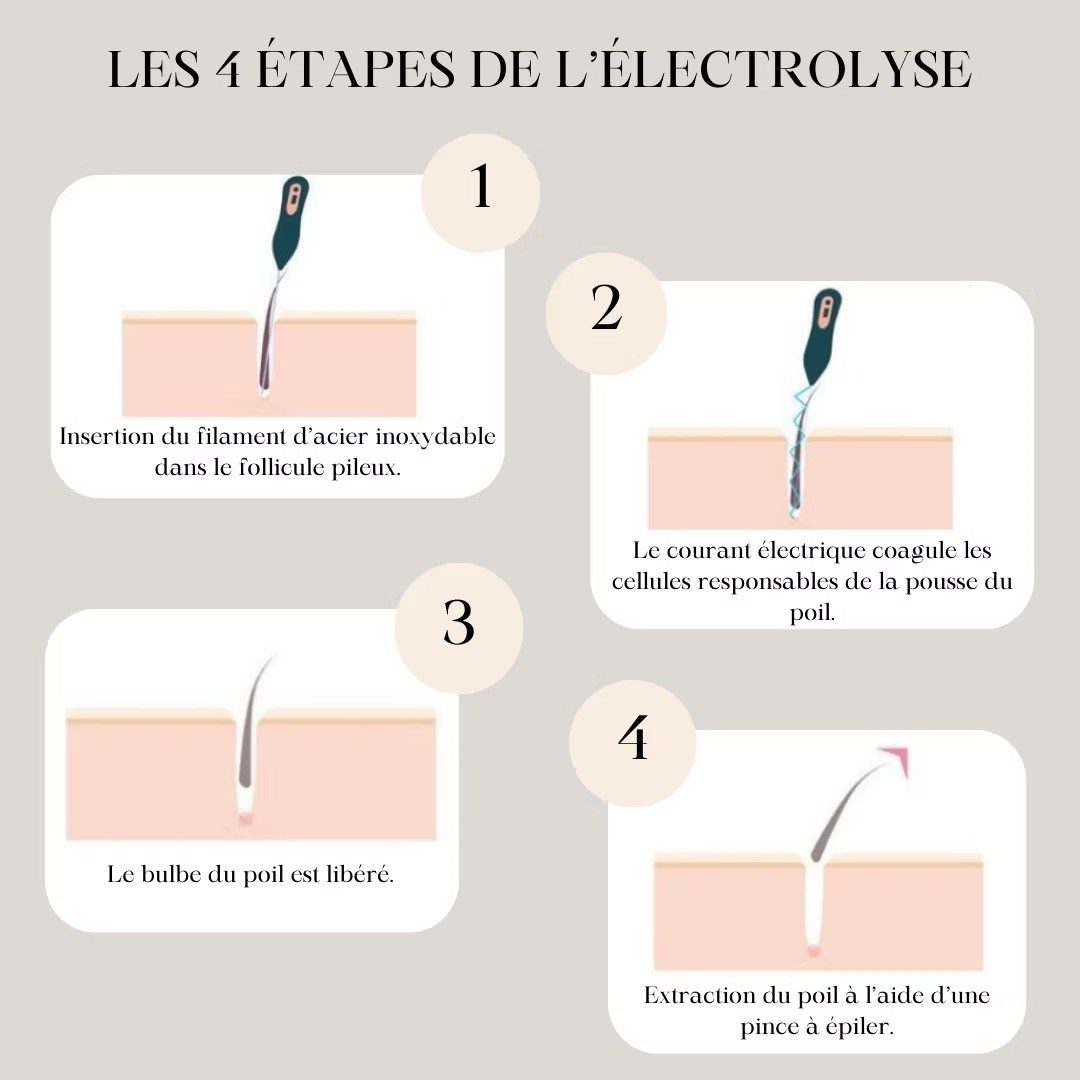 Épilation à l'électricité (Électrolyse)